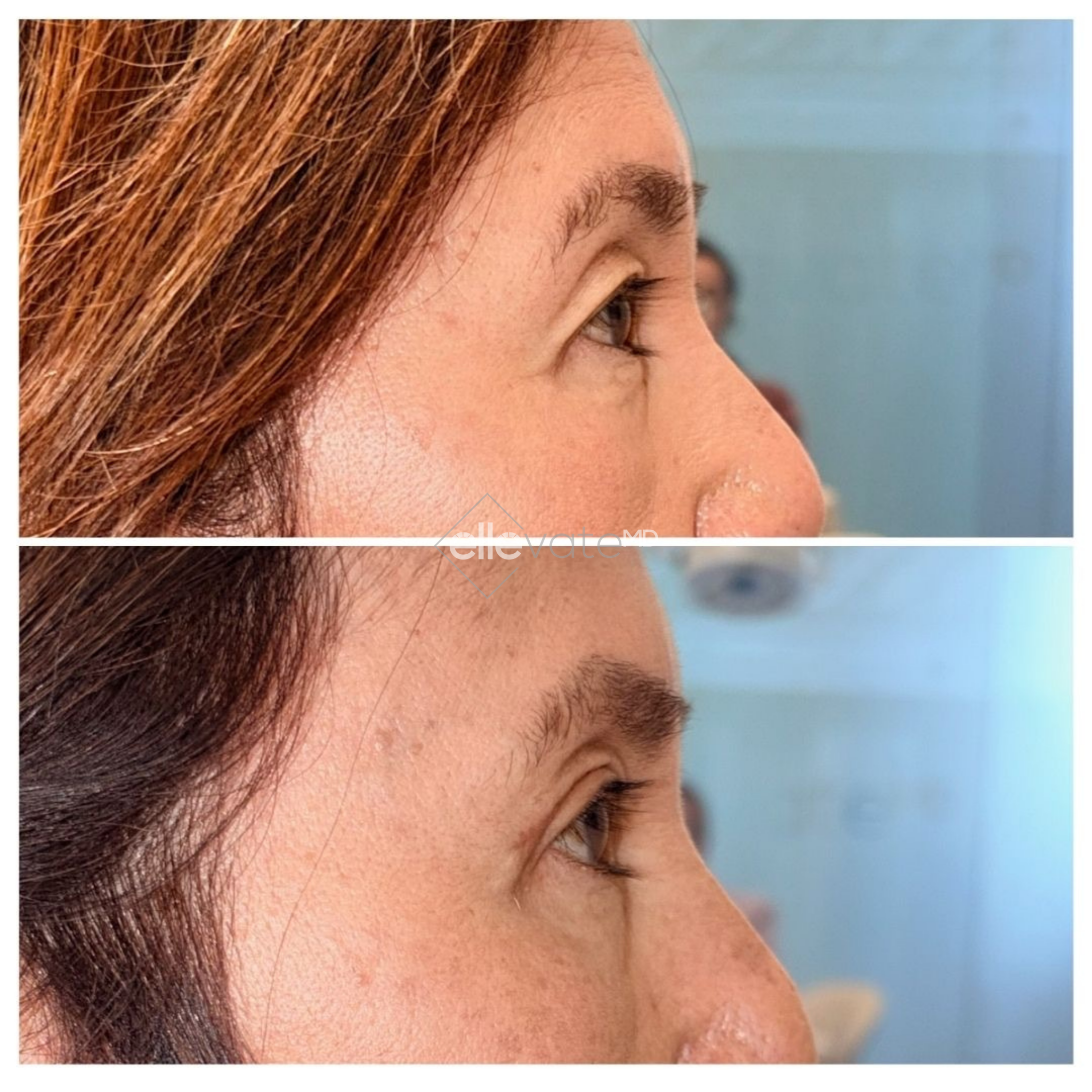 Before and after profile view of upper eyelid lift procedure demonstrating enhanced eye opening