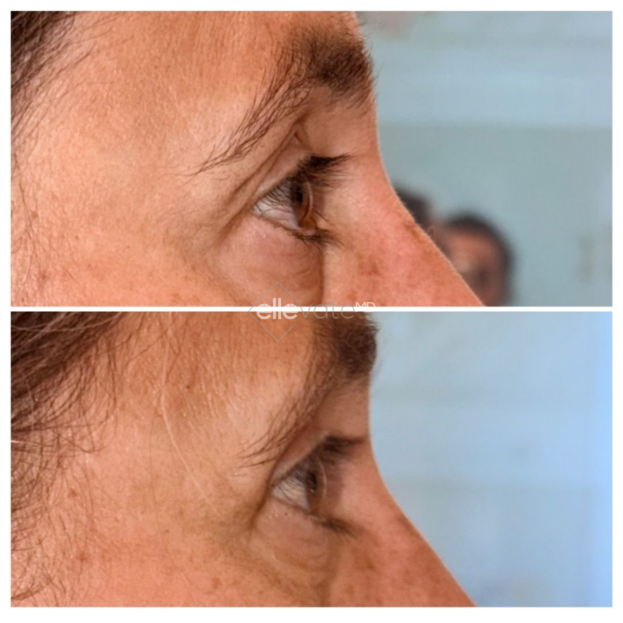 Before and after profile comparison of upper lid lift showing reduced drooping and improved definition
