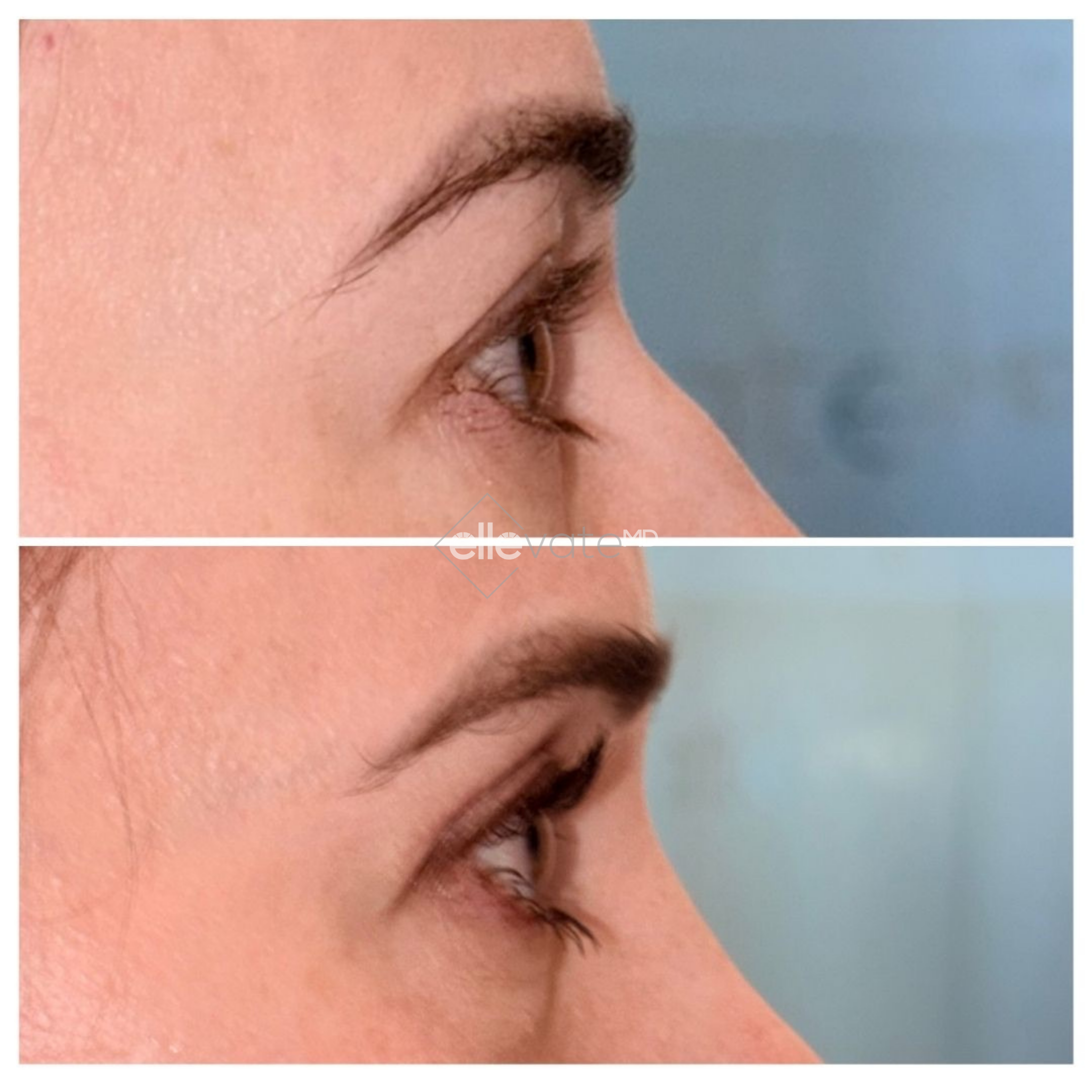 Before and after side profile of upper eyelid lift with more youthful eye position