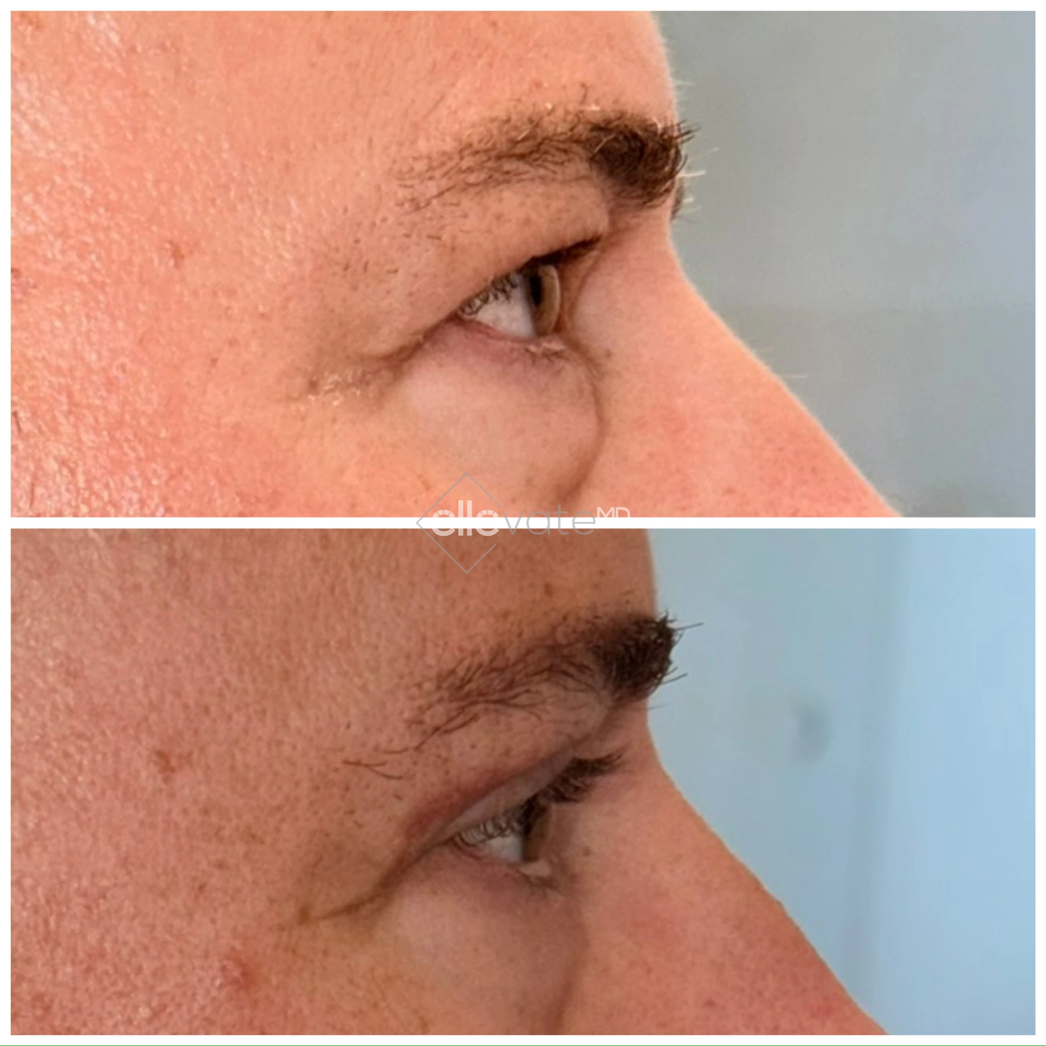 Before and after profile view of upper lid lift displaying lifted eyelid and refreshed appearance