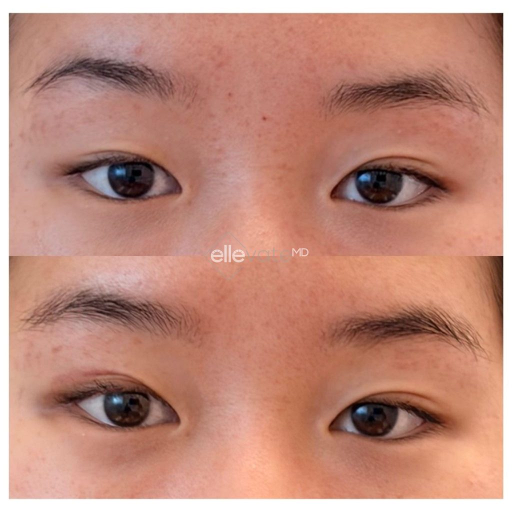 Before and after upper lid lift showing corrected eyelid asymmetry and improved lid positioning