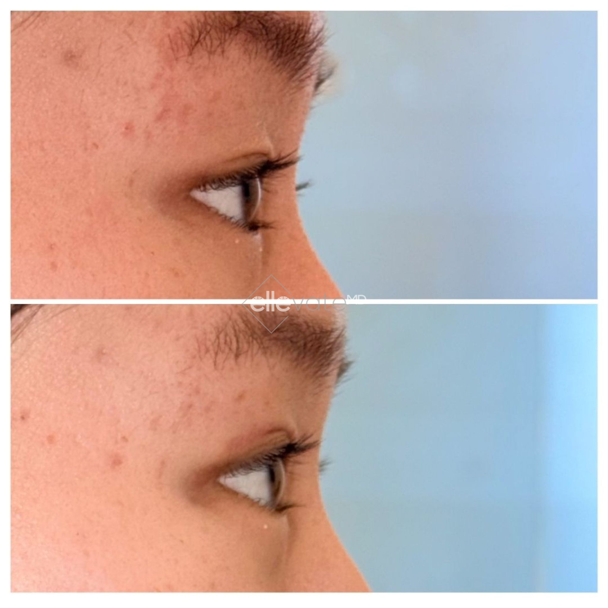 Before and after side profile showing upper eyelid lift correction for asymmetry