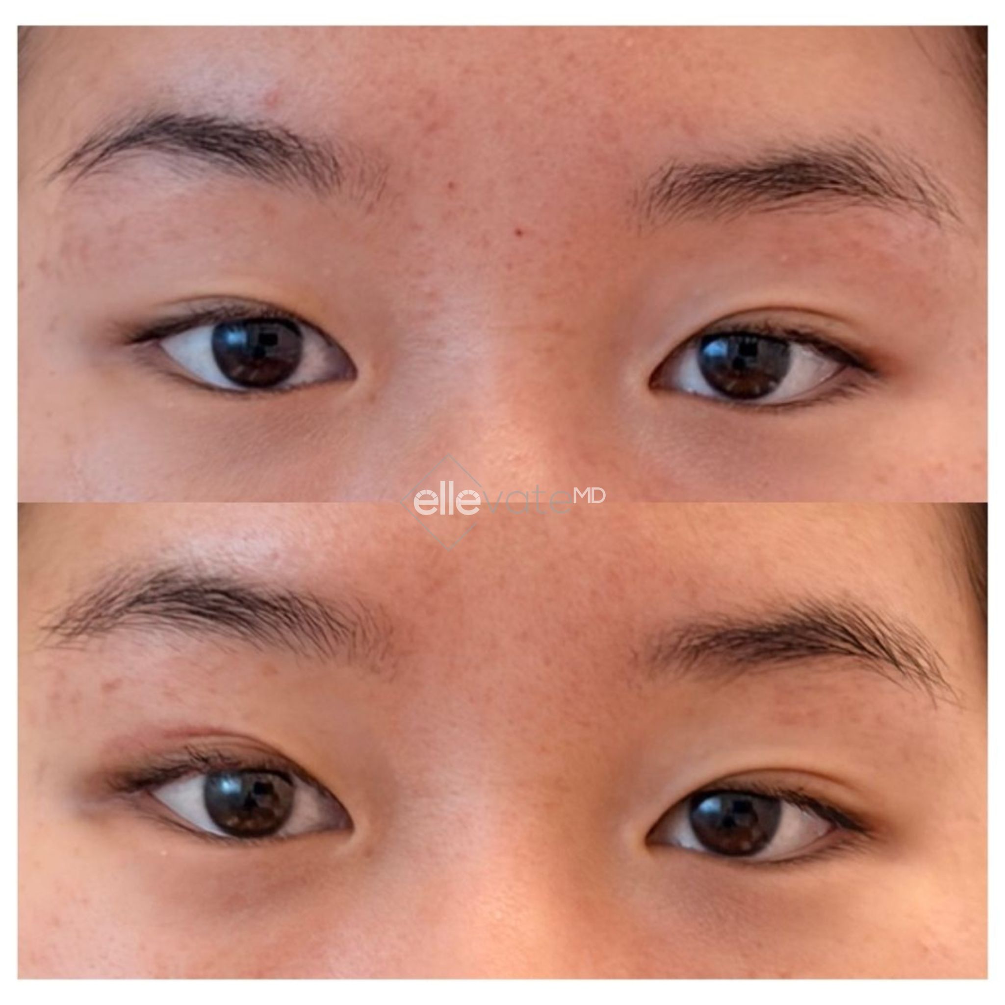 Before and after upper lid lift showing corrected eyelid asymmetry and improved lid positioning