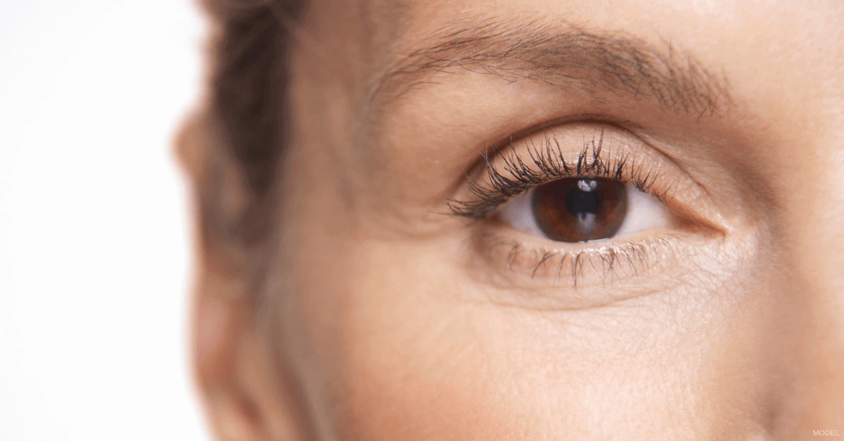 Close-up of an eye showing upper eyelid anatomy and skin texture